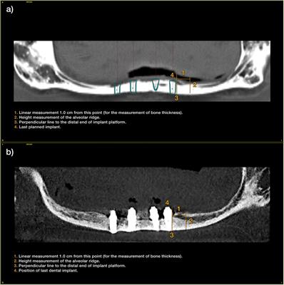 Implant-supported prosthesis under progressive loading protocol stimulates alveolar bone growth in patients with severe alveolar bone atrophy. Retrospective case series